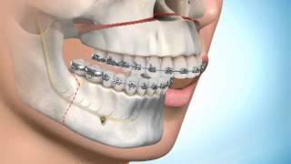 Chirurgie Maxillofaciale et orthodontie [upl. by Asiar391]