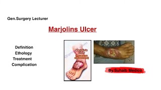 Marjolin ulcer surgery lecture surgery mbbs mbbsstudent neet2024 medical [upl. by Von]