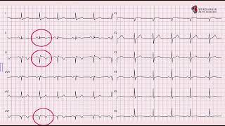 An ECG pattern in regression [upl. by Eelah367]