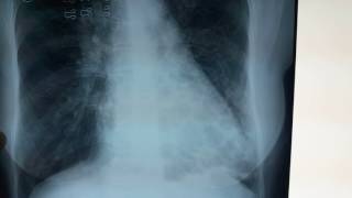 Bronchiectasis Chest Xray  What is bronchiectasis [upl. by Fortune539]