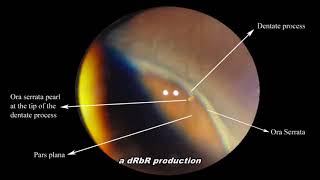 Ora Serrata pearl Scleral depression [upl. by Haelem]