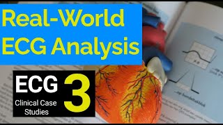 RealWorld ECG Analysis 3 Clinical Case Studies in Electrocardiography [upl. by Atiuqam]