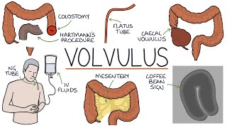 Understanding Volvulus Twisted Bowel [upl. by Nevs]