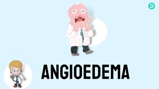 Angioedema signs amp symptoms causes and treatment [upl. by Oiramel443]