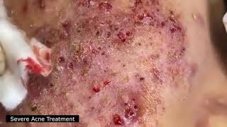 BEST BLACKHEAD AND WHITEHEAD REMOVAL SEVERE ACNE TREATMENT  SATISFYING AND RELAXING VIDEO [upl. by Ttenna]