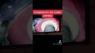 CRIOTERAPIA DEL CUELLO UTERINO  En casos de úlceras y VPH [upl. by La]