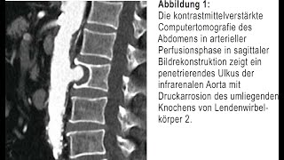 Kolikartige Flankenschmerzen bedingt durch symptomatisches Aortenulkus [upl. by Relyks644]