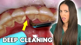 Deep Cleaning With HEAVY Tartar Build Up At The Dentist [upl. by Eniarol]