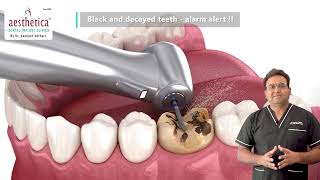 Black and Decayed Teeth What You Need to Know  Tooth Decay  Cavities  Dental Caries [upl. by Kyle636]