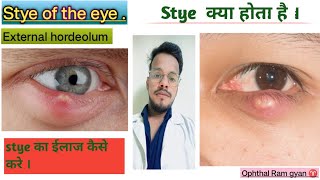 whats are stye  cause  signs and symptoms and Treatment [upl. by Vary229]