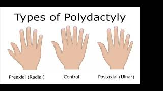 Webinar on Polydactyly Session 1 [upl. by Suiratnauq]