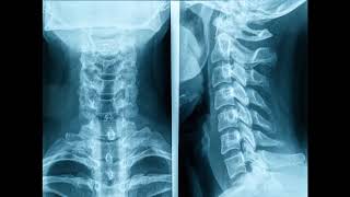 transverse process vertebral artery foramina foramen tranversarium on lateral view cervical spine [upl. by Doroteya]