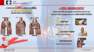 PROTESI D’ANCA MINIINVASIVA  Rubrica di Informazione Medica [upl. by Dona834]