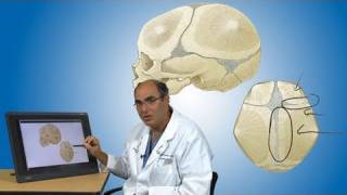 Craniosynostosis and its treatment  Boston Children’s Hospital [upl. by Bibbie115]