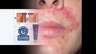 Revitol Eczema Scar Cream For Kids and Adults Treatment Review [upl. by Eerot]