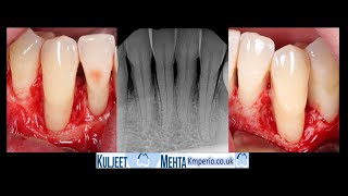 Periodontal surgery lower teeth with GTR Emdogain and OsteoBiol [upl. by Eux]