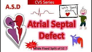 Atrial Septal Defect ASD Animation [upl. by Jarid283]