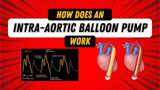 How Does an Intra Aortic Balloon Pump Work Guide for Nurses [upl. by Nathanil]