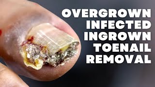 OVERGROWN INFECTED INGROWN TOENAIL REMOVAL WITH A SUPER SURPRISE [upl. by Anaujait]