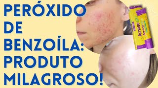 Peróxido de Benzoíla  Produtos para Acne que FUNCIONAM EP 01 🙌🏻 [upl. by Lydon]