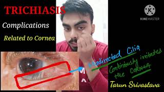 TRICHIASIS  Complete explanation of disease with its causes  complications and treatment [upl. by Ariahaj]