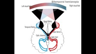 Bitemporal hemianopia [upl. by Souza]