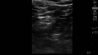 Ultrasound guided popliteal sciatic nerve block [upl. by Ecidnac]