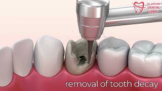 Removal of Tooth Decay [upl. by Gensler]