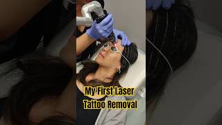 Microblading laser tattoo removal with Picosure laser [upl. by Salamanca]