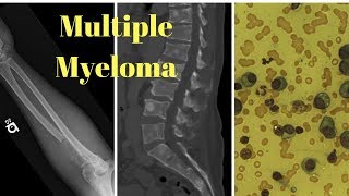 Outlook for People with Multiple Myeloma [upl. by Giffard]