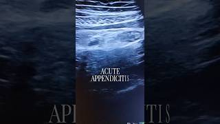 অ্যাপেন্ডিক্স এপেন্ডিসাইটিস Acute Appendicitis on Ultrasound SonographyUSG পেটে ব্যাথা। সার্জারি [upl. by Llenehs]