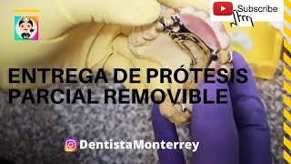 Prótesis DENTAL REMOVIBLE SUPERIOR👅 PPR Ajustes en la Entrega [upl. by Kruse]