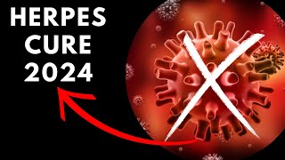 SHOCKING NEWS 2024 The CURE for HERPESSHINGLES HSV [upl. by Akahs]