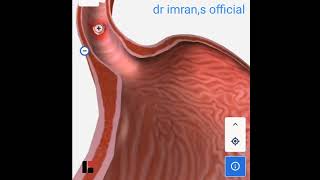 Esophegial squamus cell carcinoma [upl. by Oedama4]