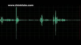 Pulmonary Stenosis mild [upl. by Llemaj]