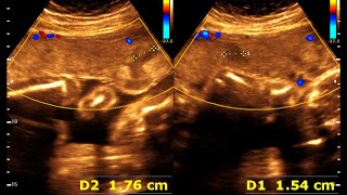 25 weeks 0 days pregnancy  Normal pregnancy  Placental lake [upl. by Swetlana892]