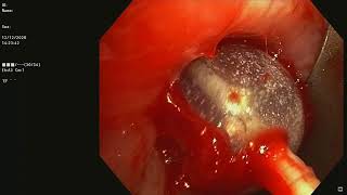 Left main bronchus tumor  Staging EBUS  Rigid Bronchoscopic tumor debulking [upl. by Anaitsirk713]