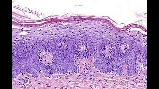 Acrodermatitis enteropathica Phillip H McKee Antonina Kalmykova  CSD Health Care [upl. by Dragelin]