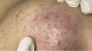 Acne treatment for Nguyen P5 HoangMySpa69 [upl. by Ahsakat]