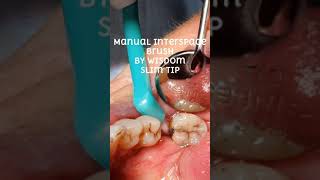 Using a manual interspace brush into a periodontal pocket gumdisease interspacebrush teeth gums [upl. by Neeruan]