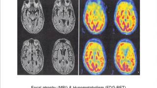 NonAlzheimers Disease Dementias [upl. by Phaedra]