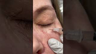 Botox Injection microtox is injected superficially for crepy skin undereyes botox aesthetics [upl. by Kamila]