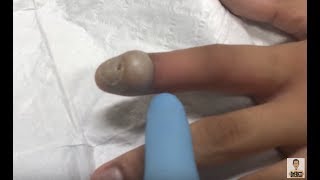 large infected bump on finger [upl. by Aynahs]