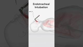 Endotracheal Intubation [upl. by Enamrej]