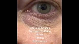 Blepharospasm shortvideoopthalmiceyesoptometristfactsstresscaffiene [upl. by Hailey]