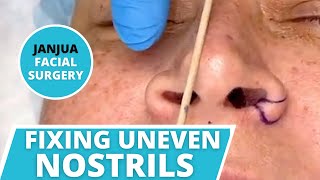 HOW TO FIX UNEVEN NOSTRILS ALARPLASTY NOSTRIL NARROWING  DR TANVEER JANJUA  NEW JERSEY [upl. by Greene]