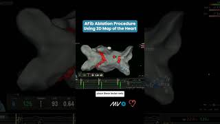 AFib Ablation Procedure Using 3D Map of Heart [upl. by Yam158]