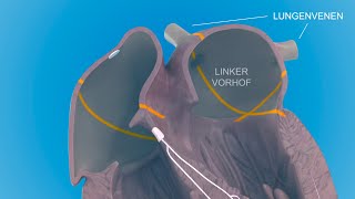 Herzrhythmusstörungen  das Vorhofflimmern [upl. by Ynoep]