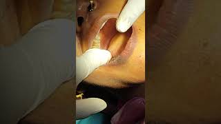 wisdom teeth removal maa ambe dental clinic thana bhipur bhagalpurdentalhealth bollywood [upl. by Singhal]