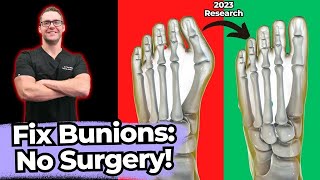 How to MASSAGE BUNIONS  Treatment Without Surgery [upl. by Darbee]